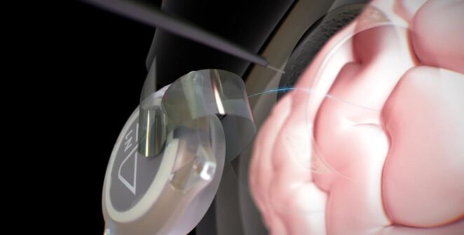 TECH HÍREK – Egy interjúban azt hallottuk, hogy 12 páciensük együttesen már közel hat éve használják az agy-számítógép interfészet (BCI-t).