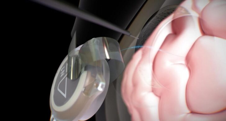 TECH HÍREK – Egy interjúban azt hallottuk, hogy 12 páciensük együttesen már közel hat éve használják az agy-számítógép interfészet (BCI-t).